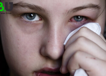 trieu-chung-dau-mat-do-2509