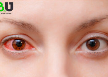 nguyen-nhan-dau-mat-do-2209