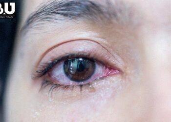 cach-tri-benh-dau-mat-do-0312