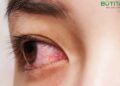 Đau mắt đỏ do virus