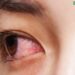 Đau mắt đỏ do virus