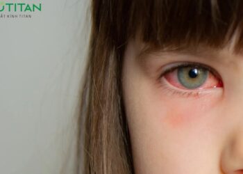 Đau mắt đỏ nhìn có lây không
