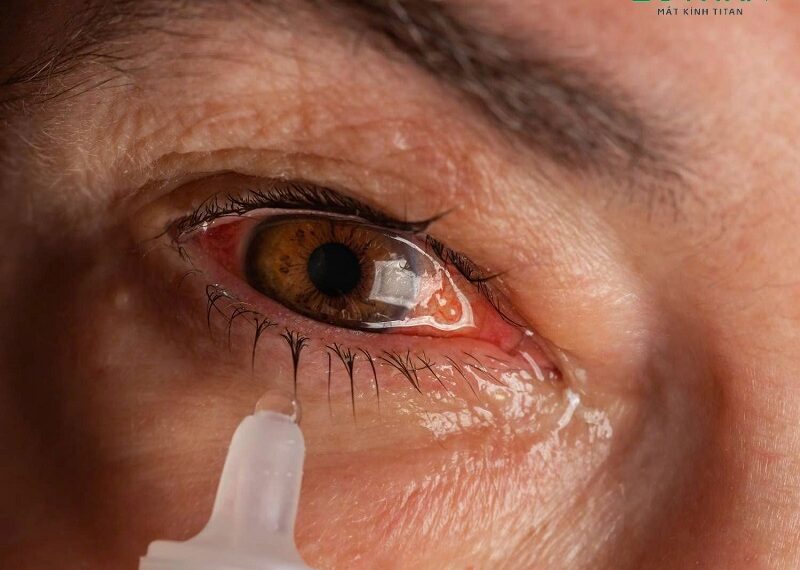 Đau mắt đỏ ở bà bầu