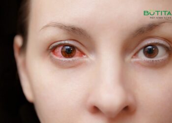 Đau mắt đỏ sau bao lâu thì khỏi