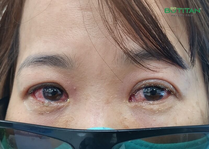 Đau mắt đỏ tái đi tái lại