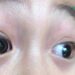 Nhận biết đau mắt đỏ