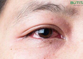 Đau mắt đỏ có bị sốt không