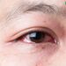 Đau mắt đỏ có bị sốt không
