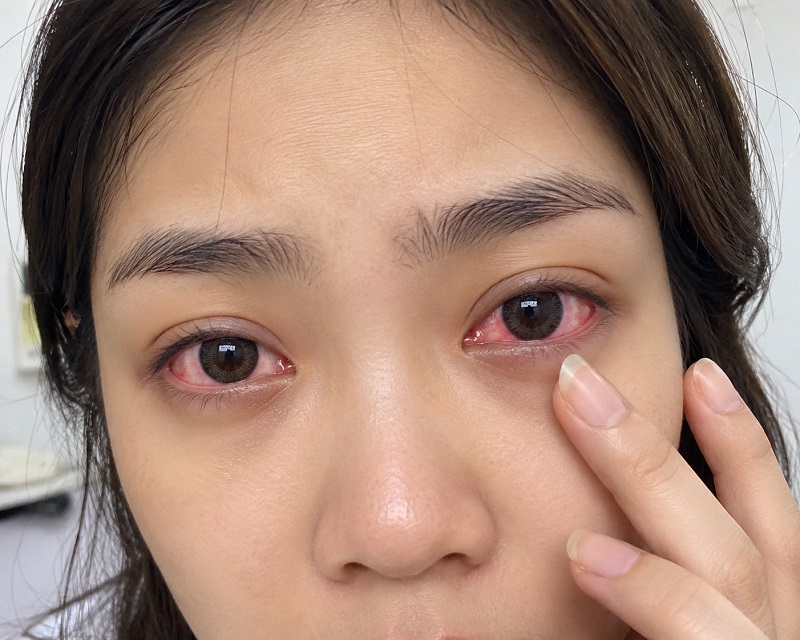 Đeo lens bị đỏ mắt thì phải làm sao