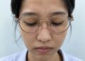 đeo kính bị hằn sống mũi