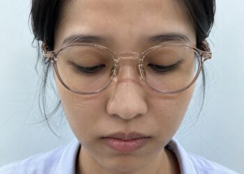 đeo kính bị hằn sống mũi