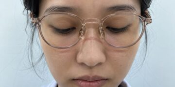 đeo kính bị hằn sống mũi