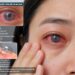 Nhiễm trùng mắt vì đeo lens